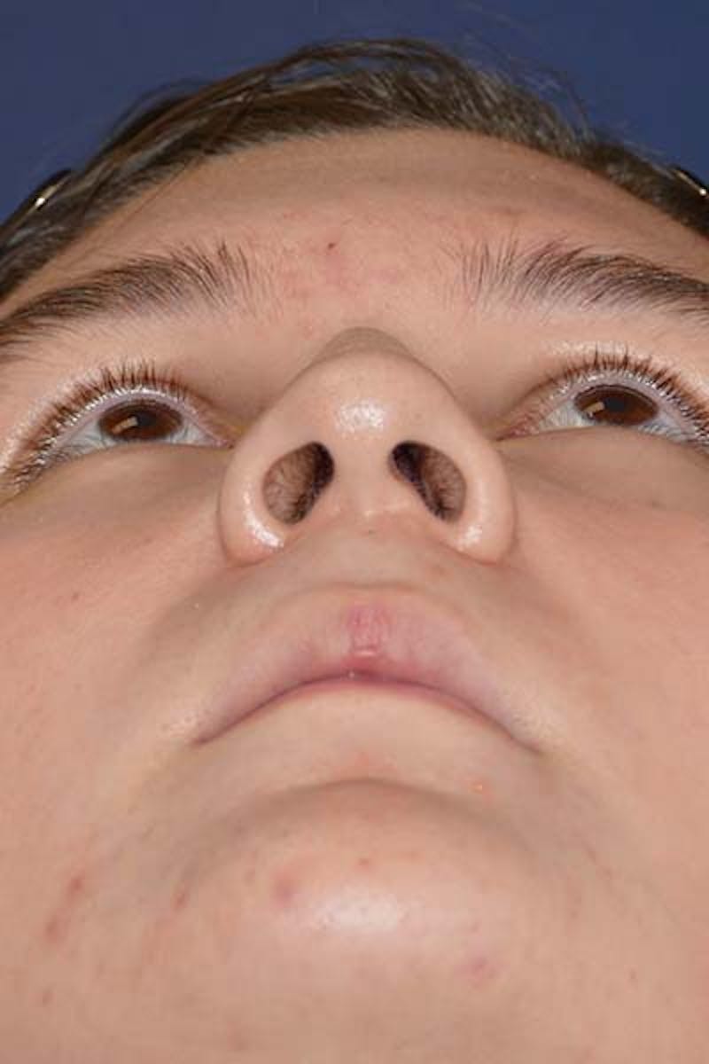 Feminizing Surgery Before & After Gallery - Patient 298211 - Image 8
