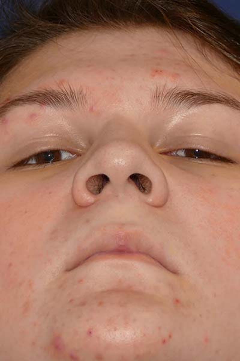 Feminizing Surgery Before & After Gallery - Patient 298211 - Image 7