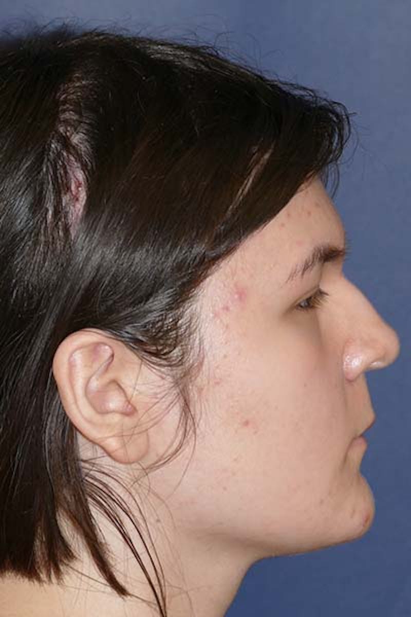 Feminizing Surgery Before & After Gallery - Patient 298211 - Image 6