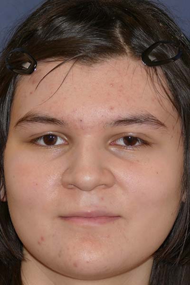 Feminizing Surgery Before & After Gallery - Patient 298211 - Image 2