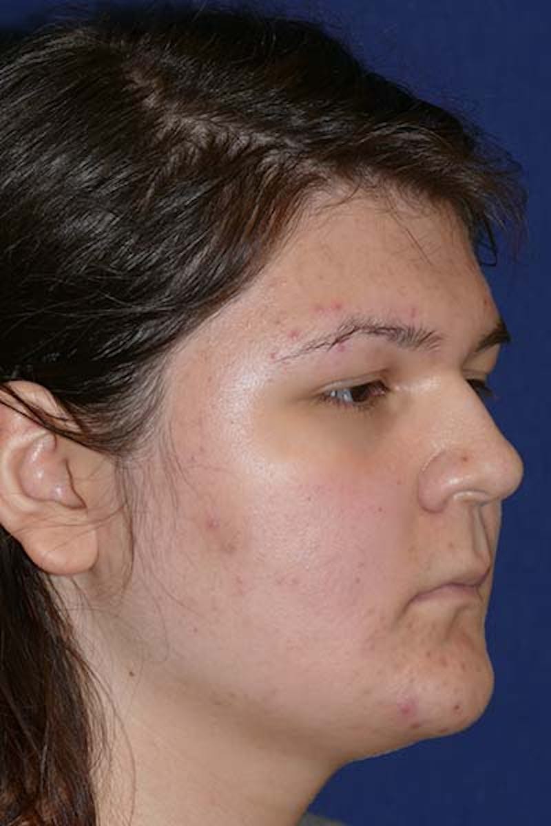 Feminizing Surgery Before & After Gallery - Patient 298211 - Image 3