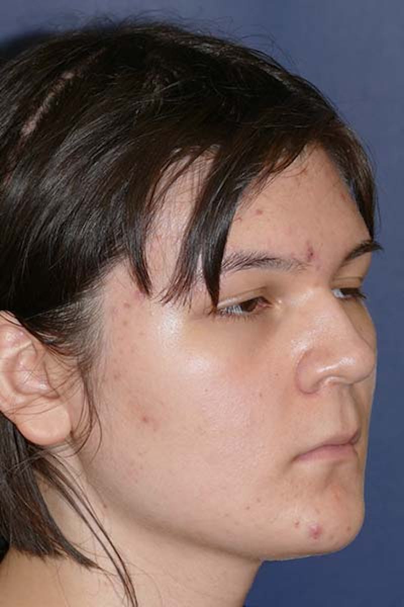 Feminizing Surgery Before & After Gallery - Patient 298211 - Image 4