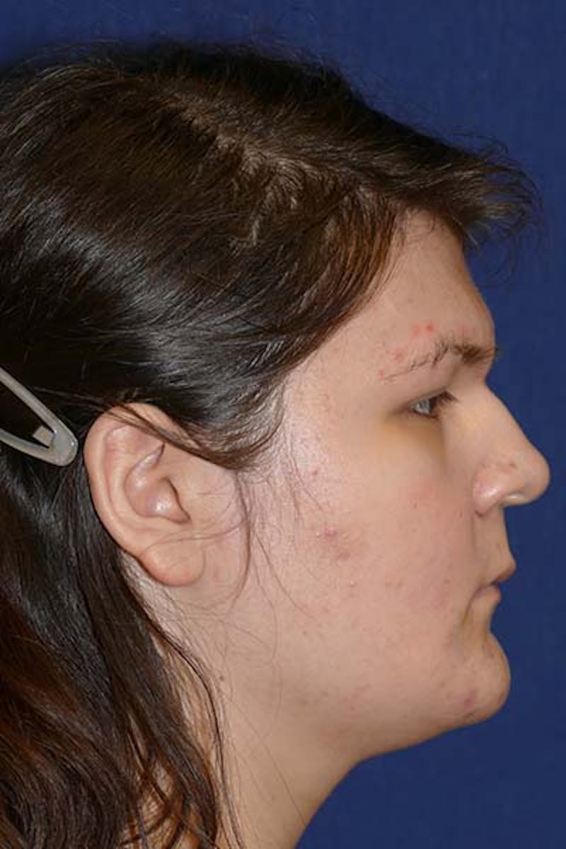 Feminizing Surgery Before & After Gallery - Patient 298211 - Image 5