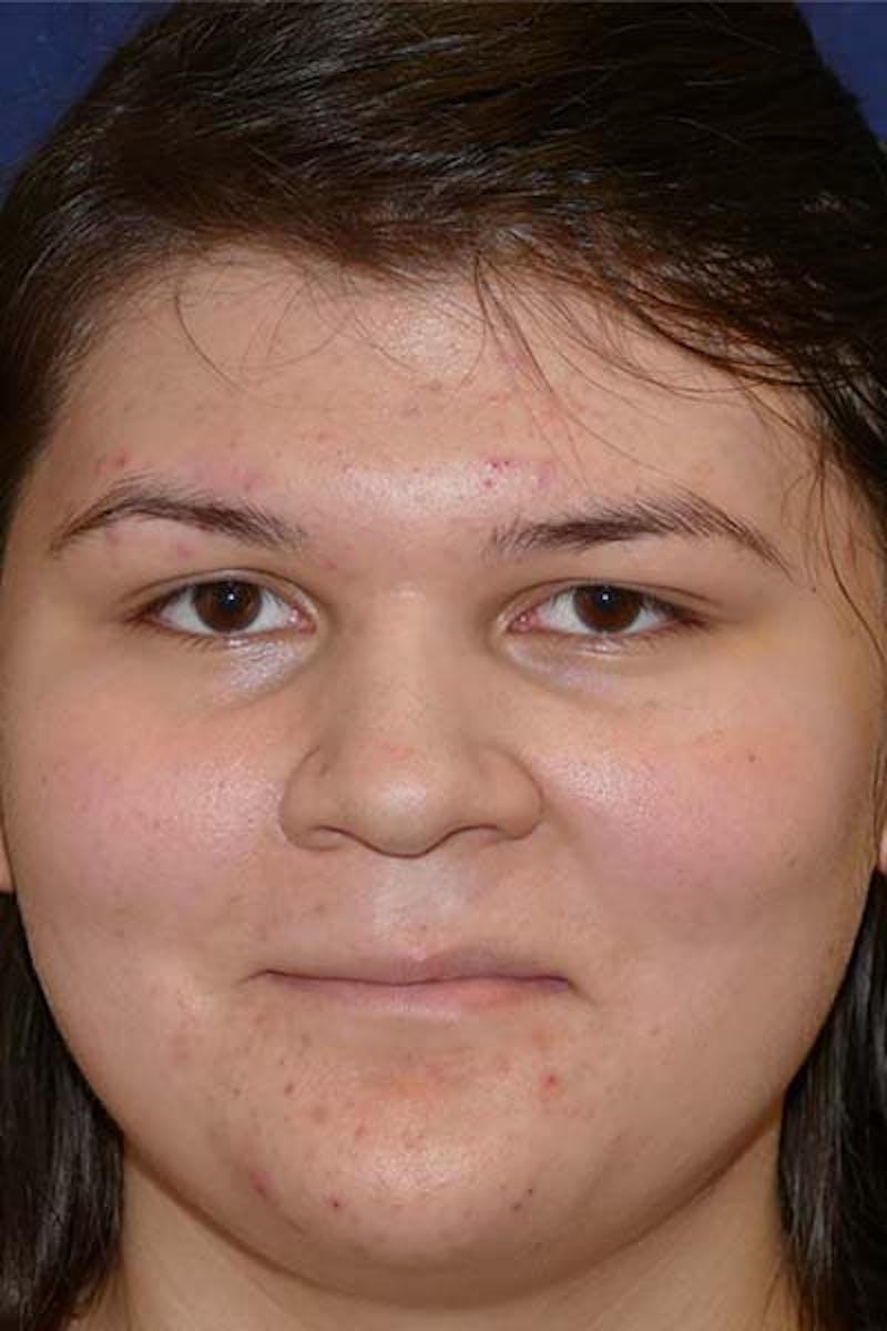 Feminizing Surgery Before & After Gallery - Patient 298211 - Image 1