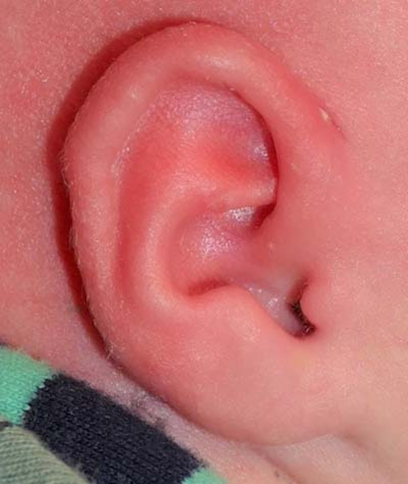 Ear Molding Before & After Gallery - Patient 159128 - Image 4