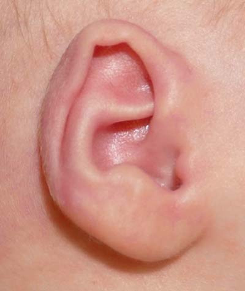 Ear Molding Before & After Gallery - Patient 159128 - Image 3