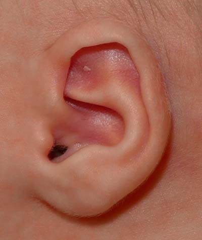 Ear Molding Before & After Gallery - Patient 159128 - Image 1