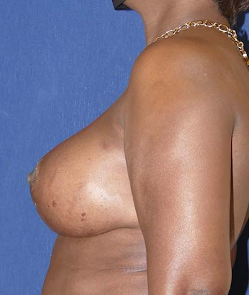 Breast Lift Before & After Gallery - Patient 390228 - Image 10