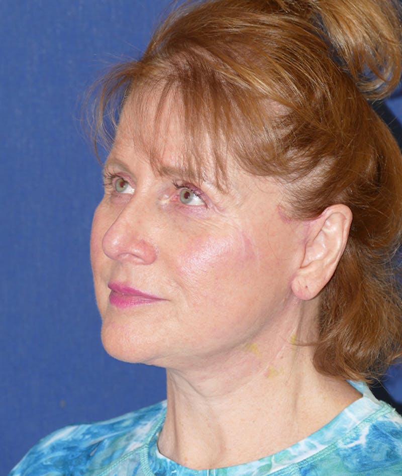 Facelift Before & After Gallery - Patient 414452 - Image 4