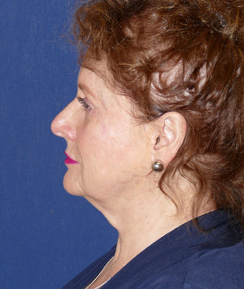 Facelift Before & After Gallery - Patient 414452 - Image 5