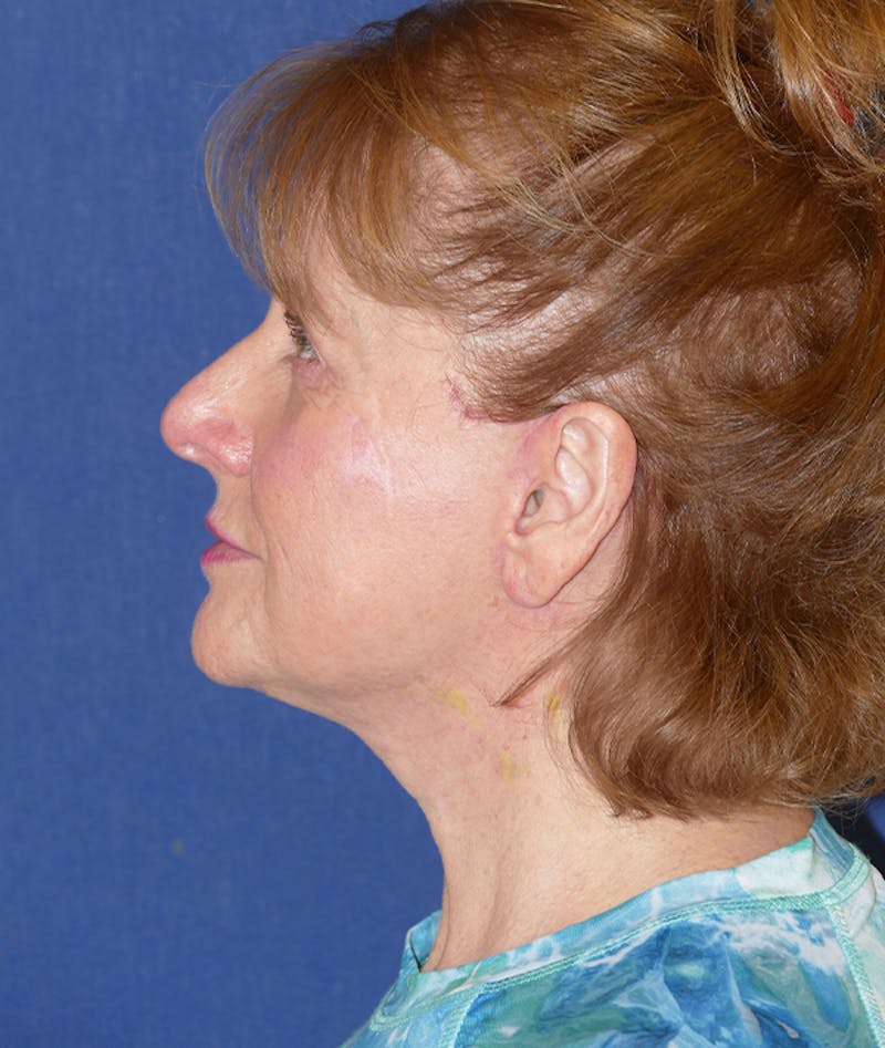 Facelift Before & After Gallery - Patient 414452 - Image 6