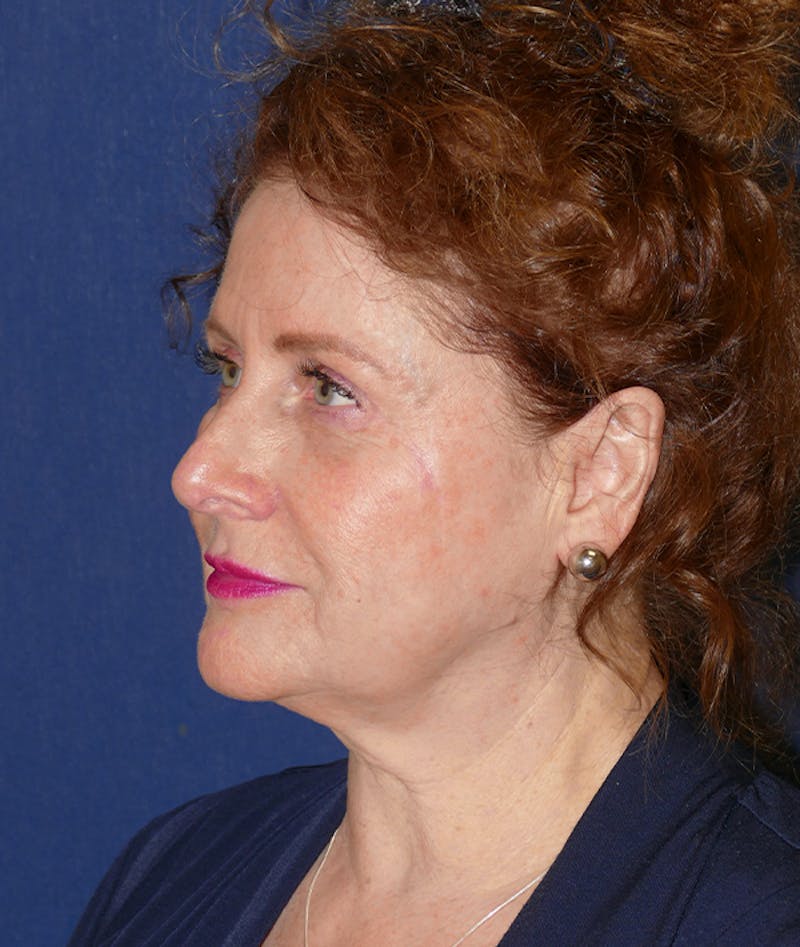 Facelift Before & After Gallery - Patient 414452 - Image 3