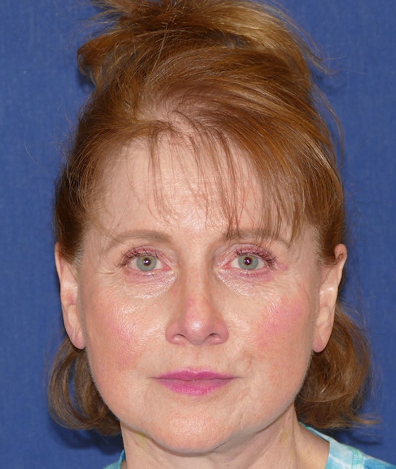 Facelift Before & After Gallery - Patient 414452 - Image 2