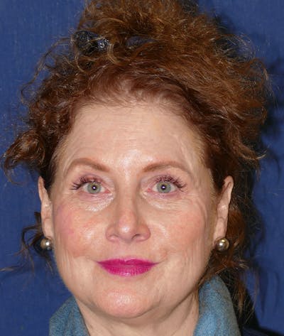 Facelift Before & After Gallery - Patient 414452 - Image 1