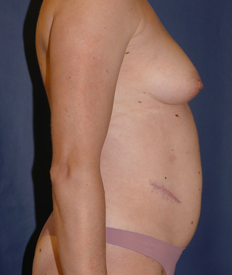 Mommy Makeover Before & After Gallery - Patient 149642 - Image 5