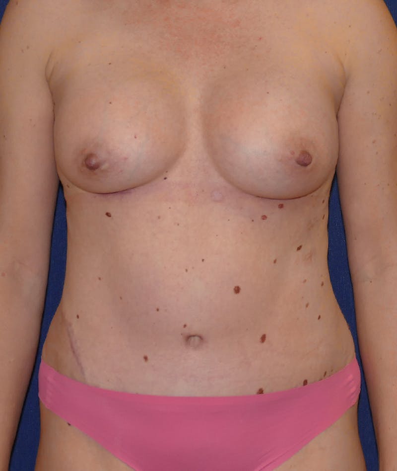 Mommy Makeover Before & After Gallery - Patient 149642 - Image 2