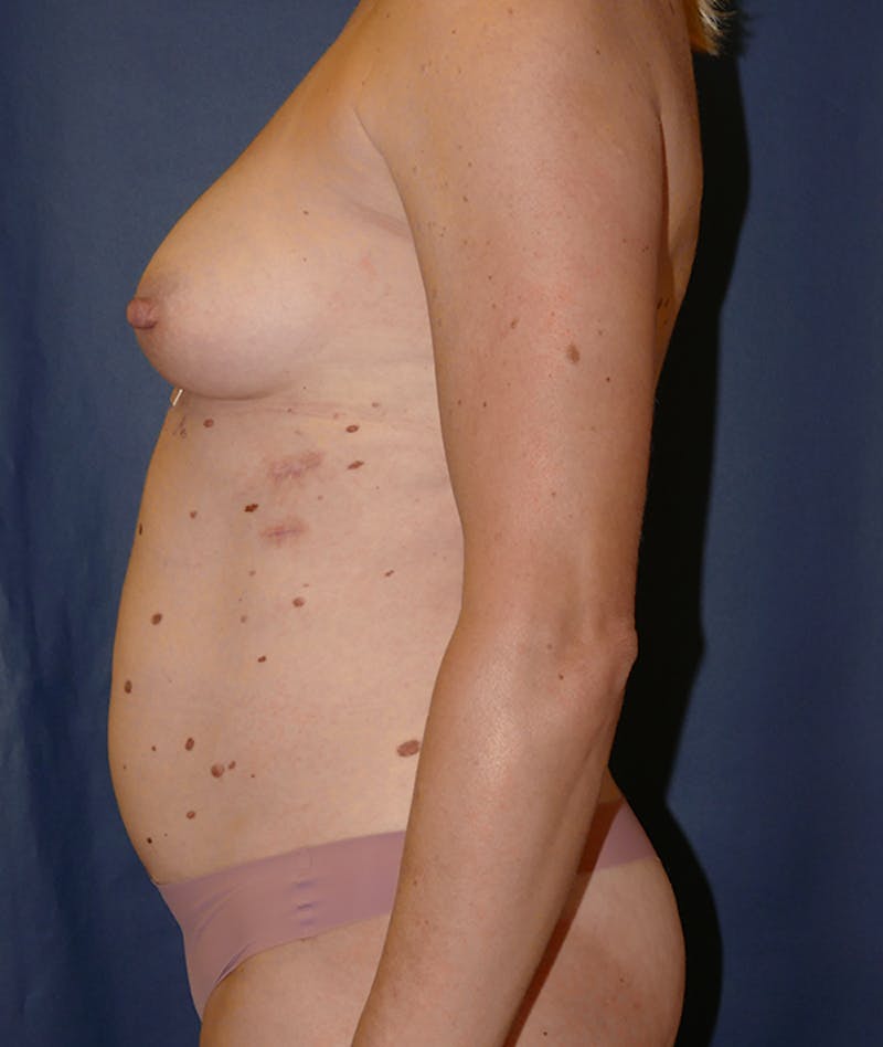Mommy Makeover Before & After Gallery - Patient 149642 - Image 3