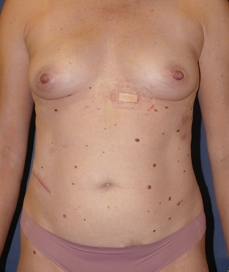 Mommy Makeover Before & After Gallery - Patient 149642 - Image 1