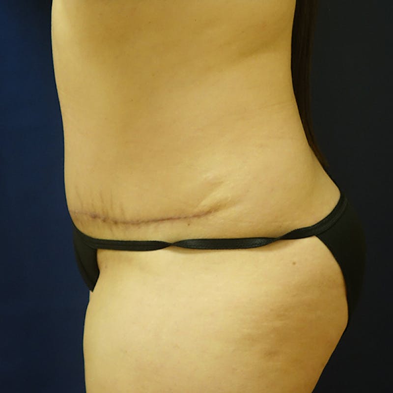 Tummy Tuck (Abdominoplasty) Before & After Gallery - Patient 105419 - Image 6