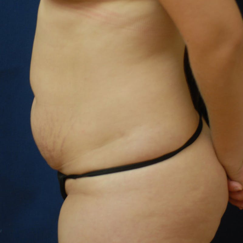 Tummy Tuck (Abdominoplasty) Before & After Gallery - Patient 105419 - Image 5