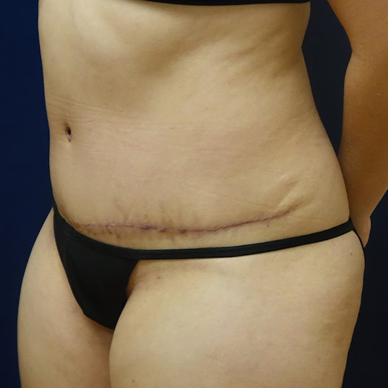 Tummy Tuck (Abdominoplasty) Before & After Gallery - Patient 105419 - Image 4