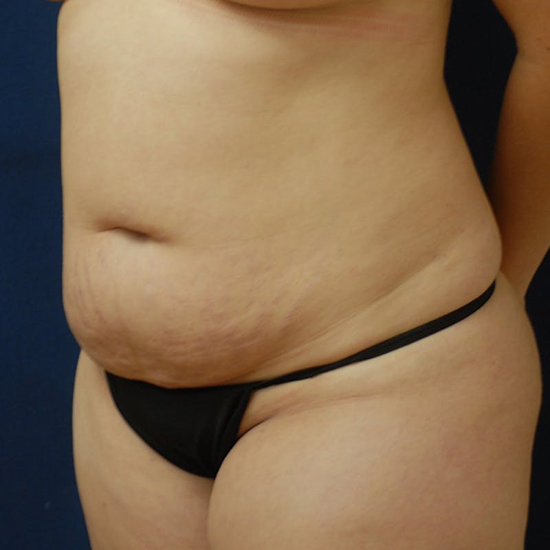 Tummy Tuck (Abdominoplasty) Before & After Gallery - Patient 105419 - Image 3