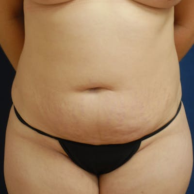 Tummy Tuck (Abdominoplasty) Before & After Gallery - Patient 105419 - Image 1