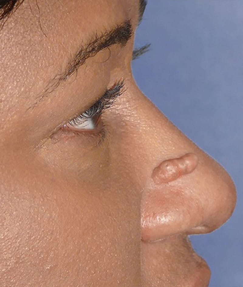 Miscellaneous Before & After Gallery - Patient 239870 - Image 7
