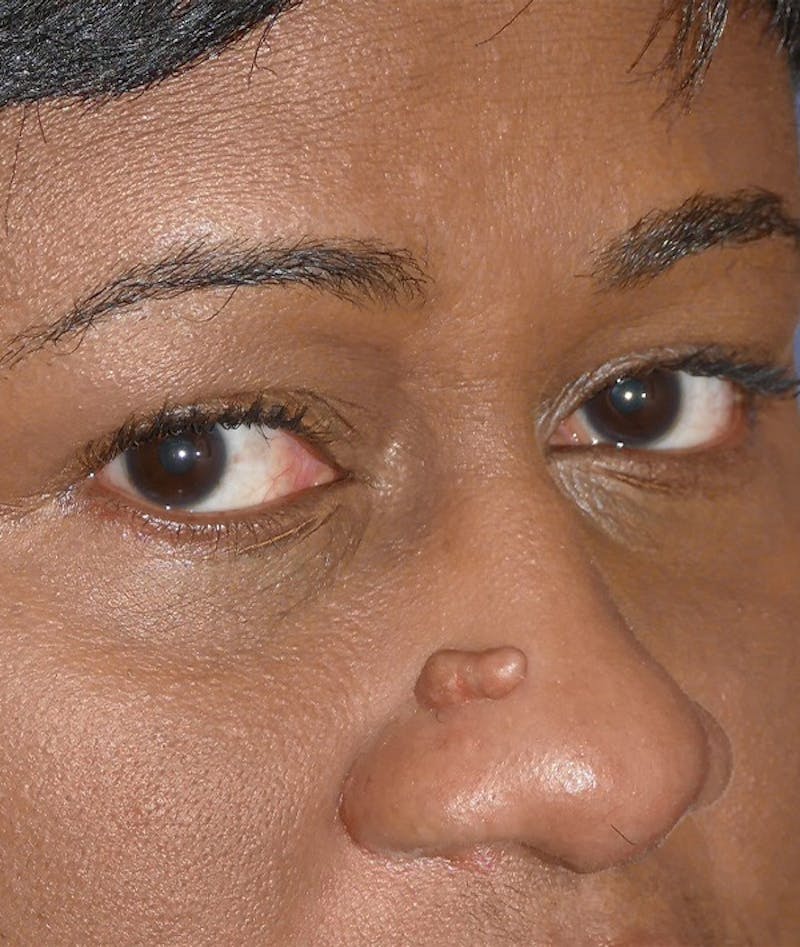 Miscellaneous Before & After Gallery - Patient 239870 - Image 5