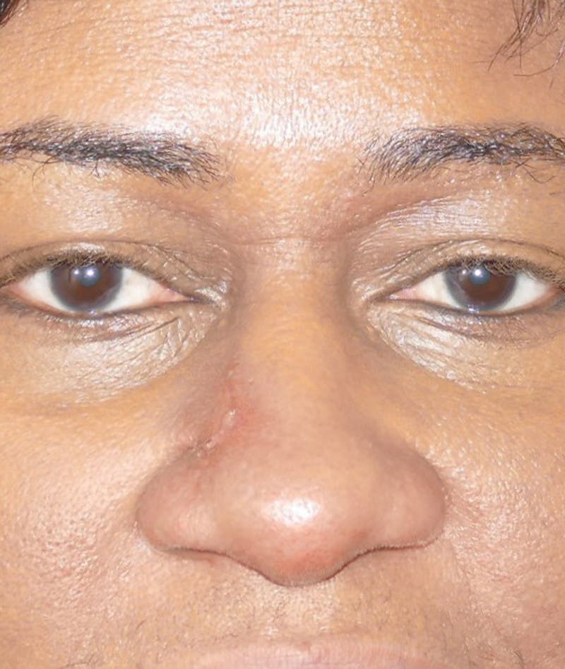 Miscellaneous Before & After Gallery - Patient 239870 - Image 4
