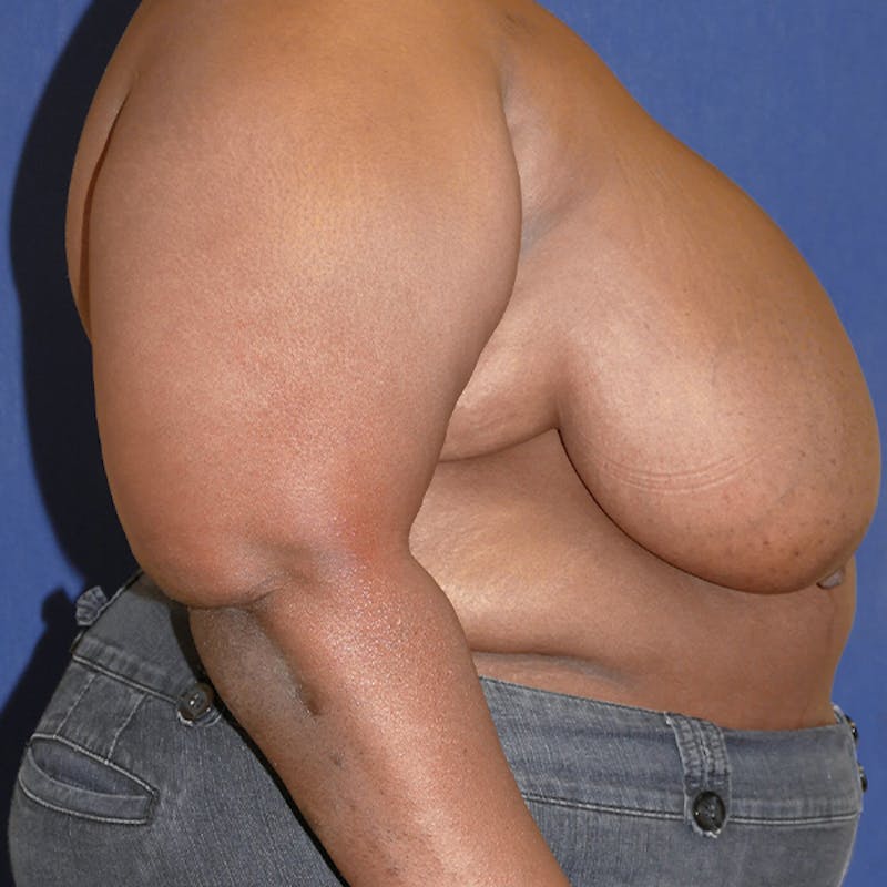 Breast Reduction Before & After Gallery - Patient 191241 - Image 9