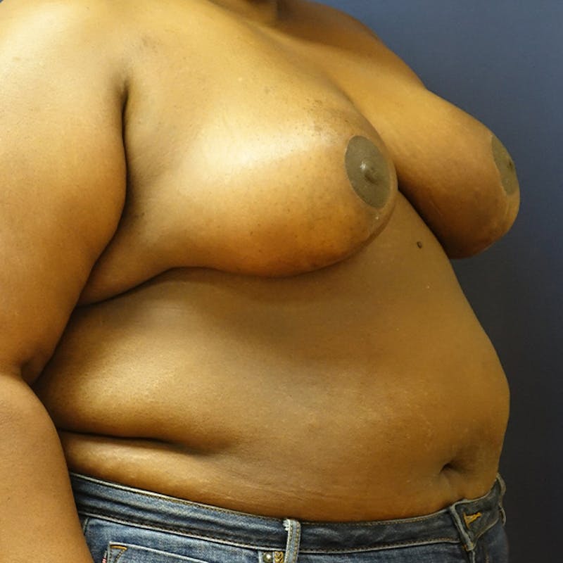 Breast Reduction Before & After Gallery - Patient 191241 - Image 8