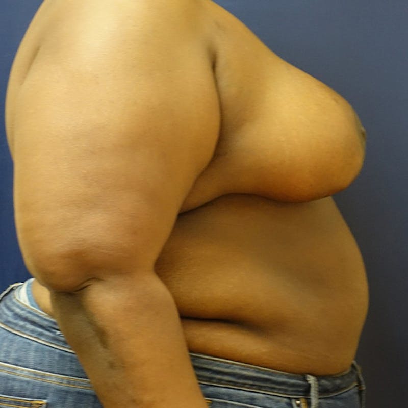 Breast Reduction Before & After Gallery - Patient 191241 - Image 10