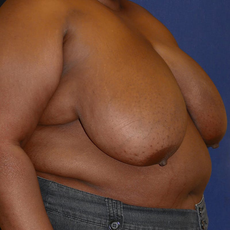 Breast Reduction Before & After Gallery - Patient 191241 - Image 7