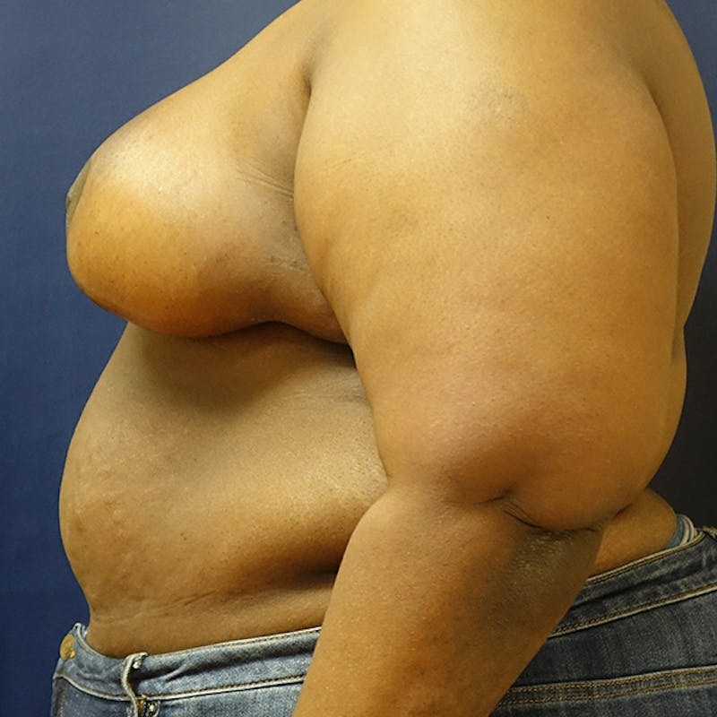Breast Reduction Before & After Gallery - Patient 191241 - Image 6