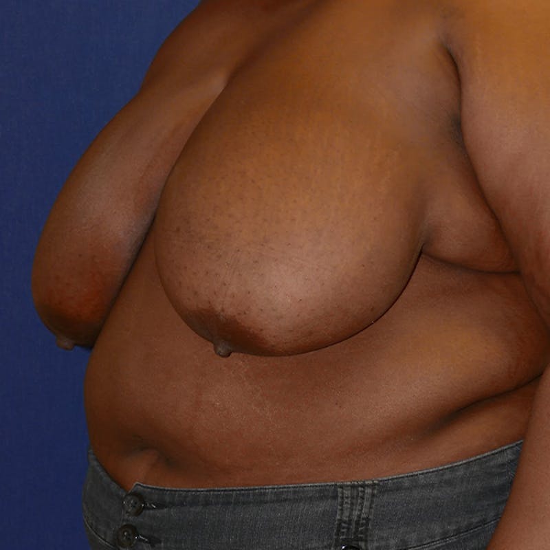 Breast Reduction Before & After Gallery - Patient 191241 - Image 3
