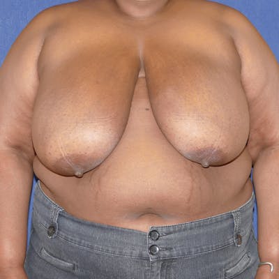 Breast Reduction Before & After Gallery - Patient 191241 - Image 1