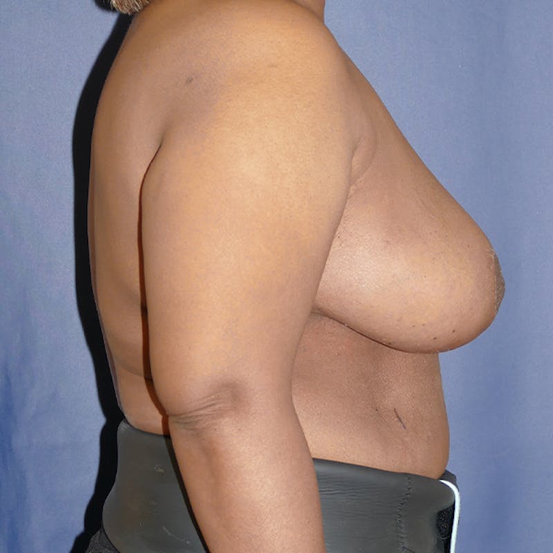 Breast Reduction Before & After Gallery - Patient 306013 - Image 6