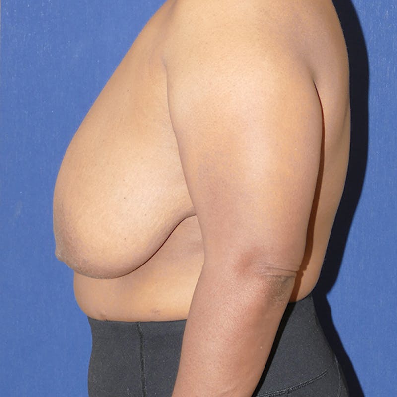 Breast Reduction Before & After Gallery - Patient 306013 - Image 3