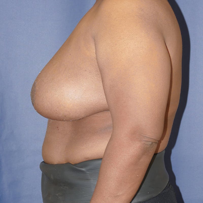 Breast Reduction Before & After Gallery - Patient 306013 - Image 4