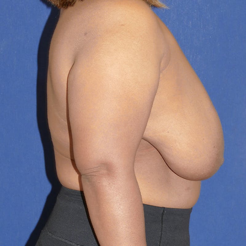 Breast Reduction Before & After Gallery - Patient 306013 - Image 5