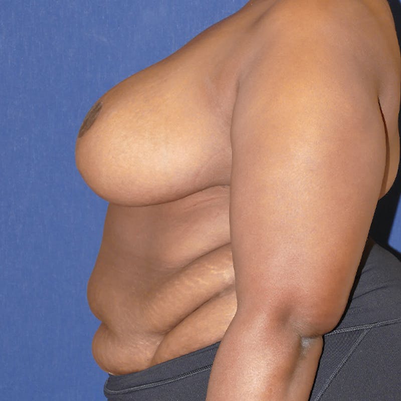 Breast Reduction Before & After Gallery - Patient 200803 - Image 10