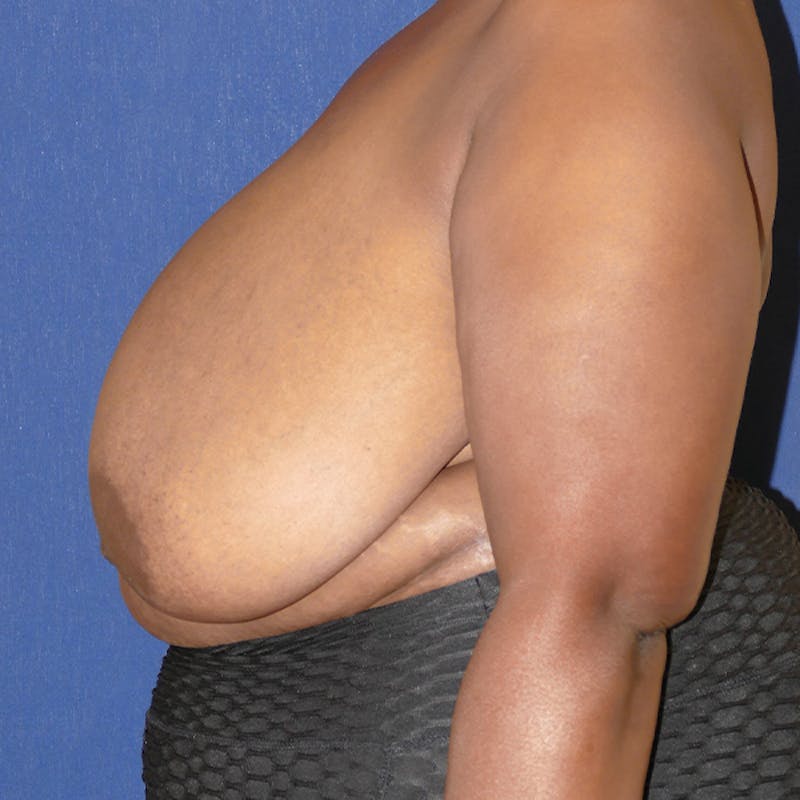 Breast Reduction Before & After Gallery - Patient 200803 - Image 9