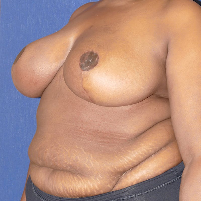 Breast Reduction Before & After Gallery - Patient 200803 - Image 8