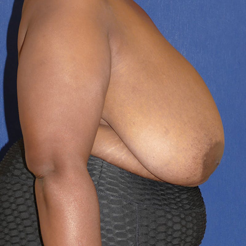 Breast Reduction Before & After Gallery - Patient 200803 - Image 5