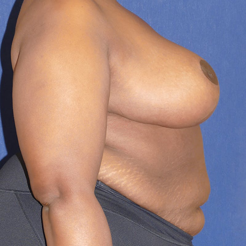 Breast Reduction Before & After Gallery - Patient 200803 - Image 6