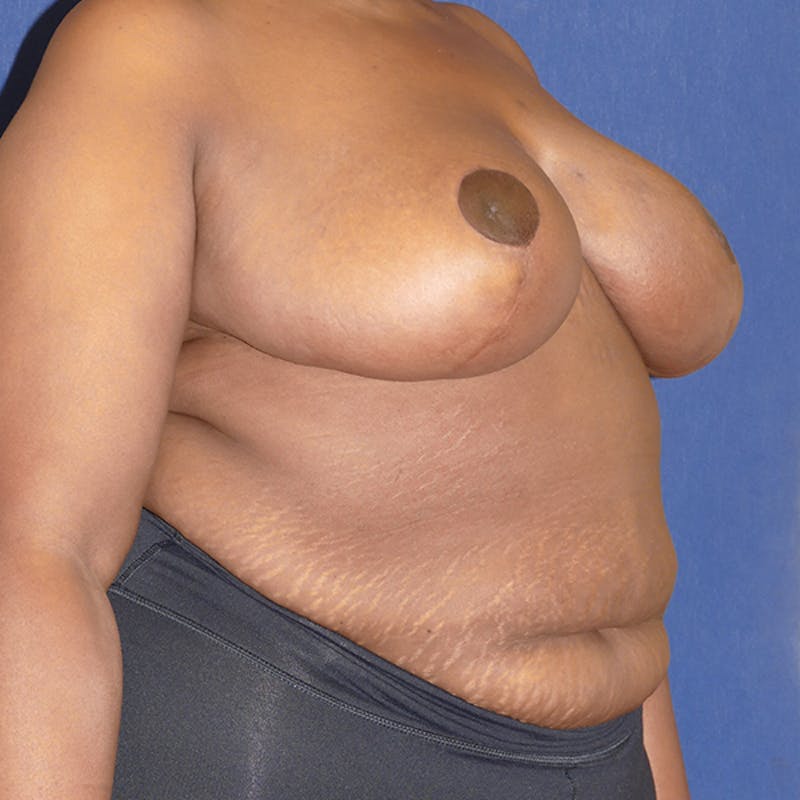 Breast Reduction Before & After Gallery - Patient 200803 - Image 4