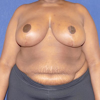 Breast Reduction Before & After Gallery - Patient 200803 - Image 2