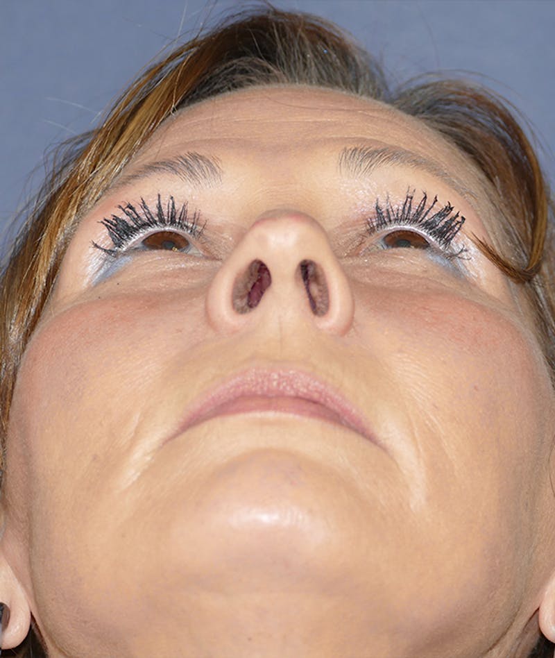 Rhinoplasty Before & After Gallery - Patient 266289 - Image 5