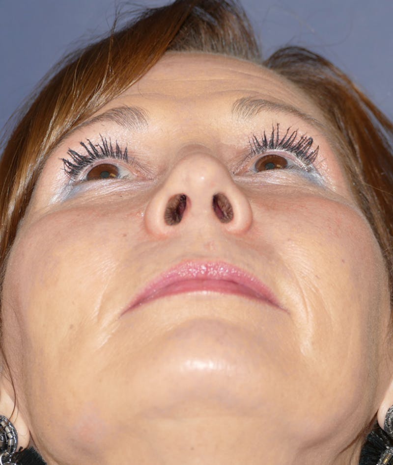 Rhinoplasty Before & After Gallery - Patient 266289 - Image 6